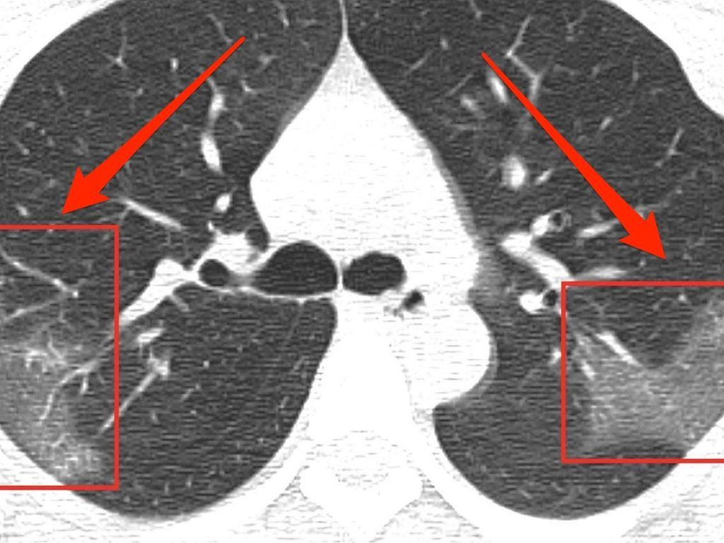 Hình chụp CT vùng ngực của một bệnh nhân COVID-19. Ảnh: Business Insider.